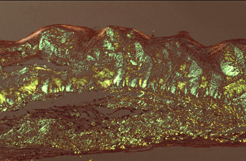 File:Gelatinous drop-like corneal dystrophy 5.JPEG