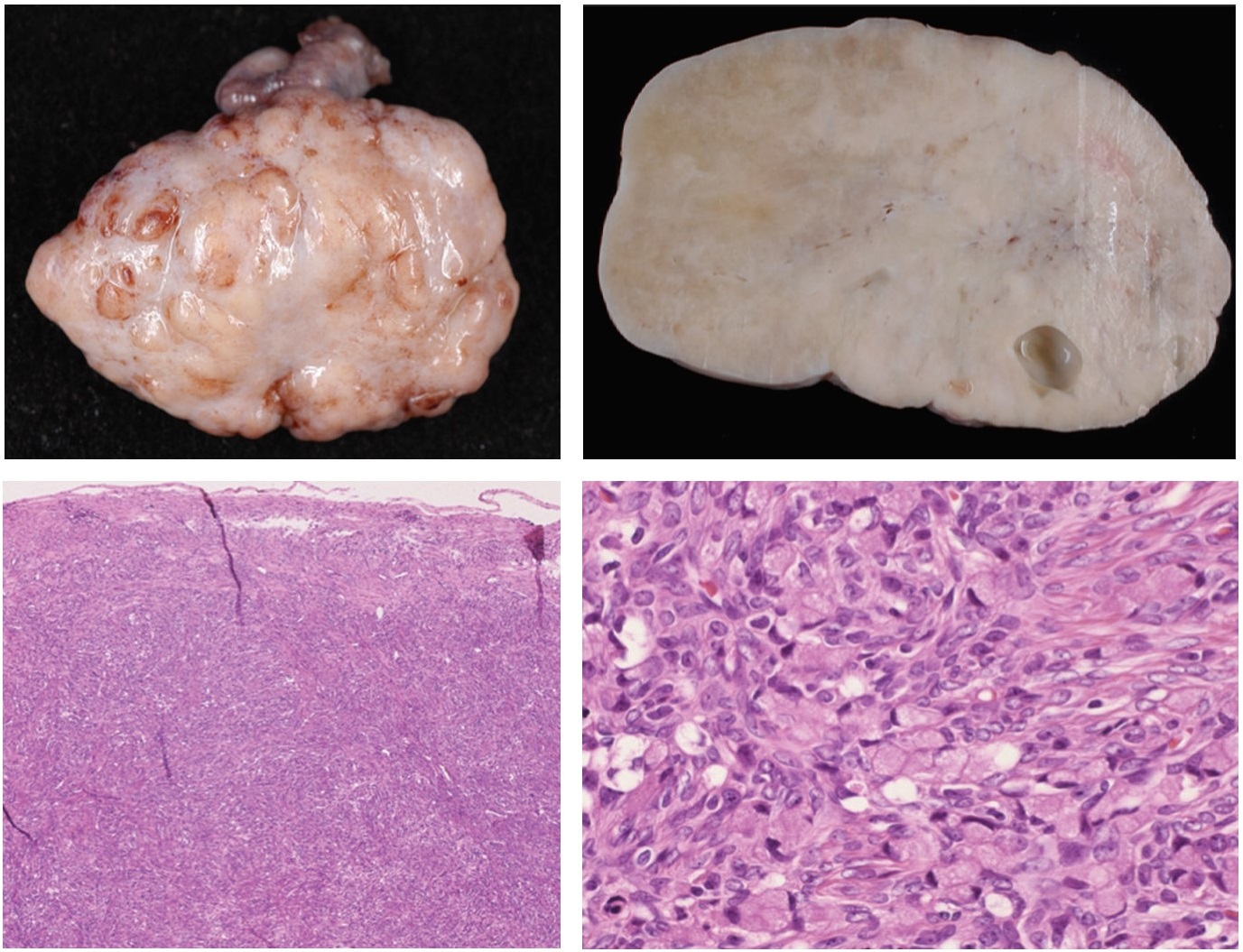 Gross pathology and histopathology of signet ring cell carcinoma metastasis to the ovary.jpg