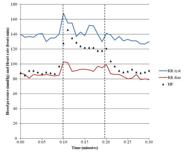 Tilt table test - Mayo Clinic