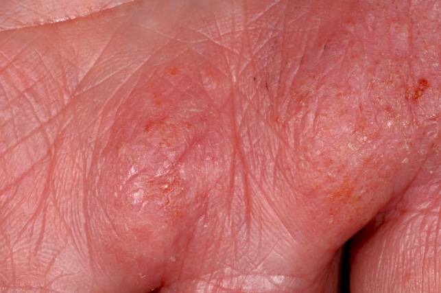 eczema hands