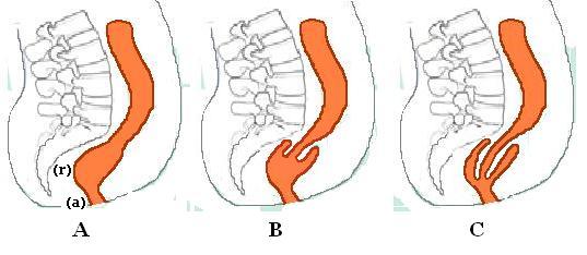 A. Normal anatomy: (r) rectum, (a) anal canal
B. Recto-rectal intussusception
C. Recto-anal intussusception Internal rectal intussusception.jpg
