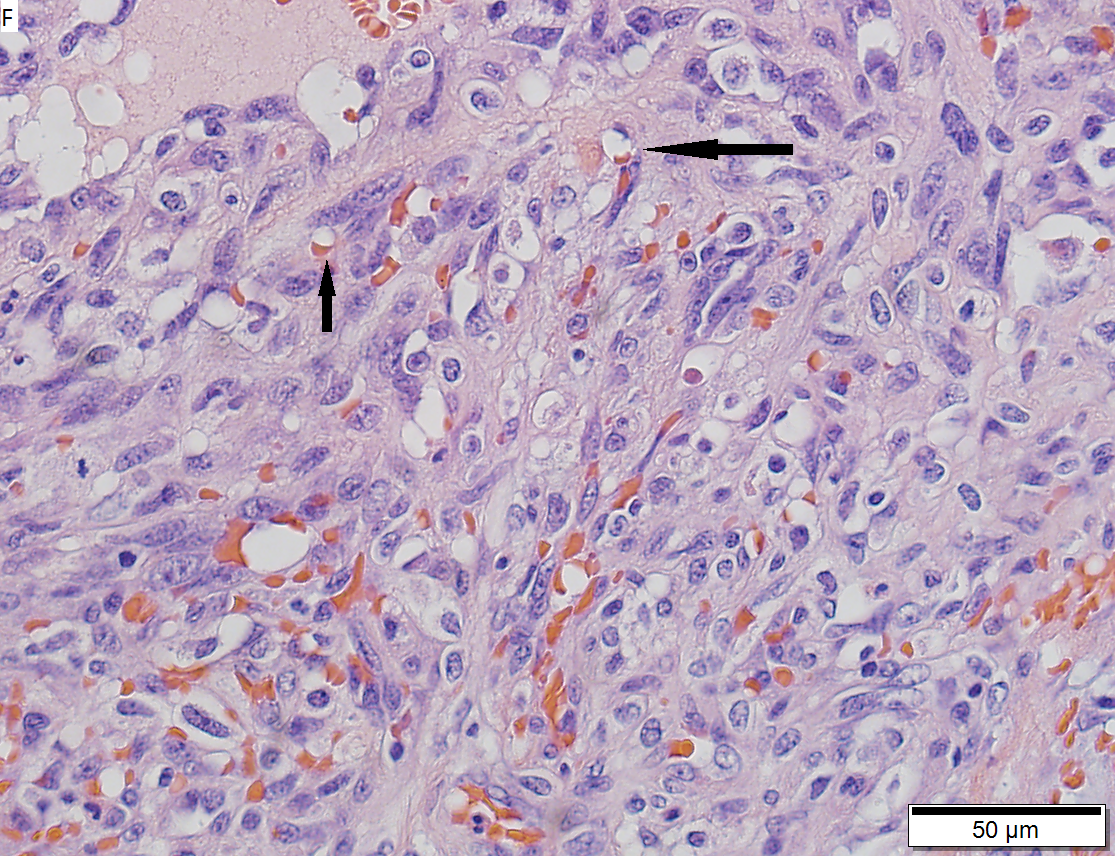 Angiosarcoma of right atrium