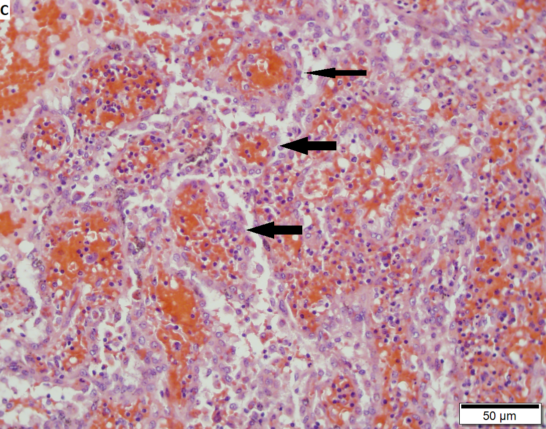 Littoral cell angioma of spleen