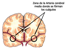 File:ArteriaCerebral.jpg