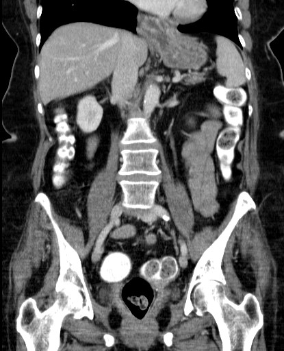 File:Bouveret-Syndrom case 001 - CT - coronar - 015.jpg