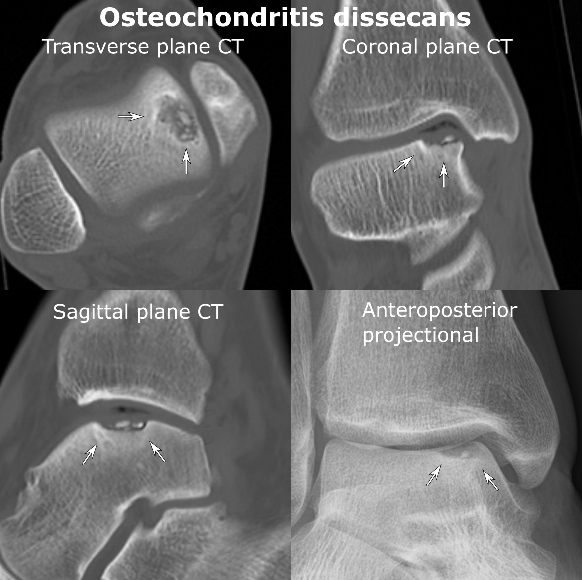 osteochondritis dissecans ct