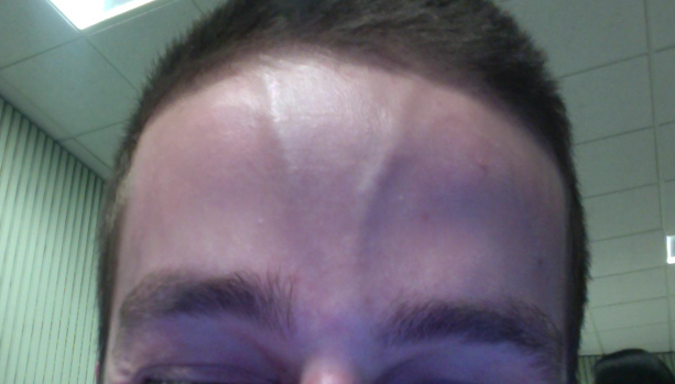 File:Supratrochlear artery forehead.png