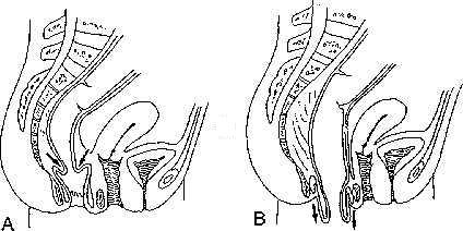 424px x 212px - Rectal prolapse - Wikipedia