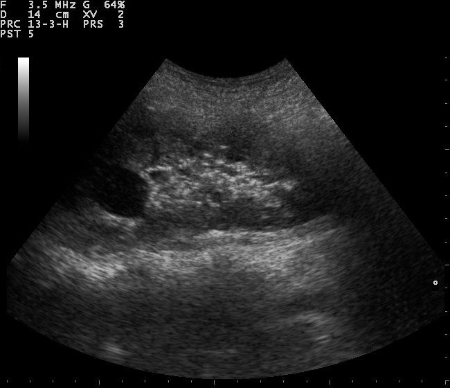 File:Renal cyst ultrasound 110316115548 1203320.jpg