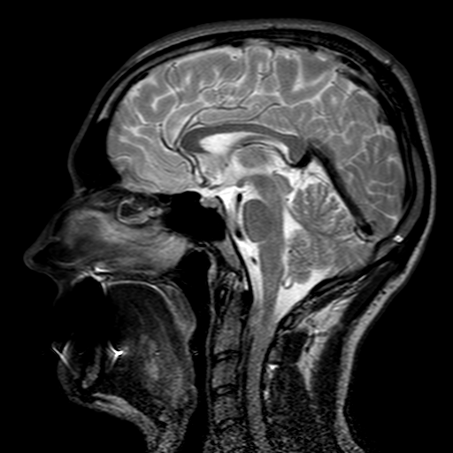 File:Head MRI, enlarged inferior sagittal sinus.png