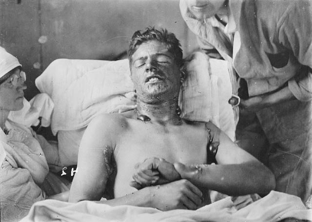  Mustard gas burns 