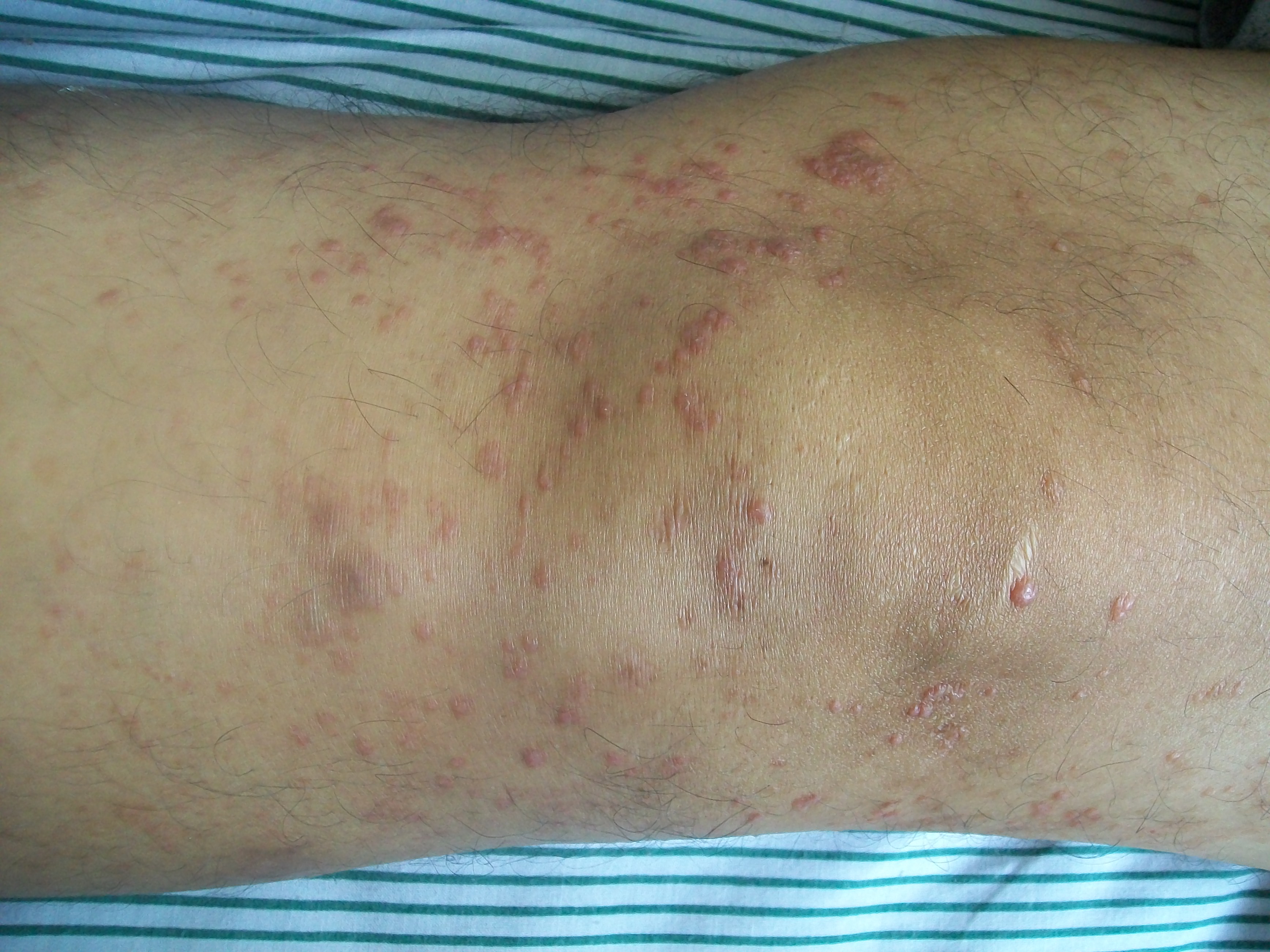 Rash - Wikipedia