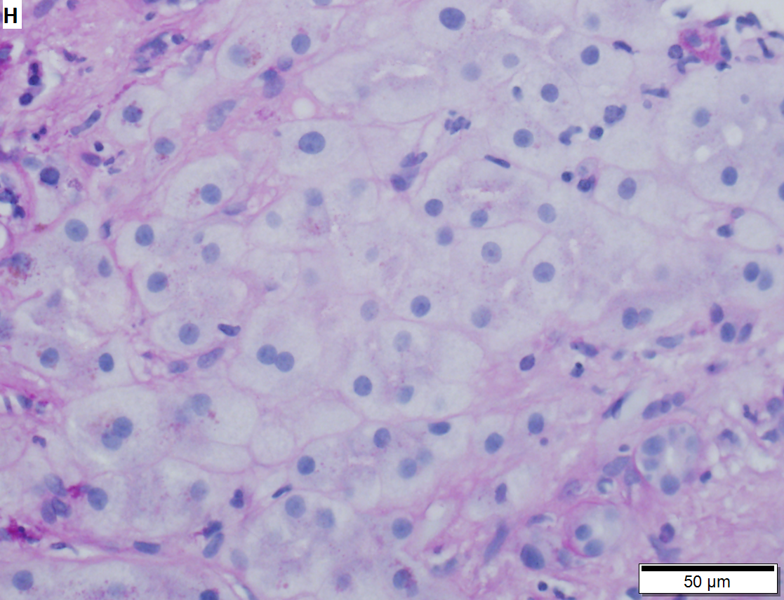 Hepatocellular carcinoma arising in cirrhosis