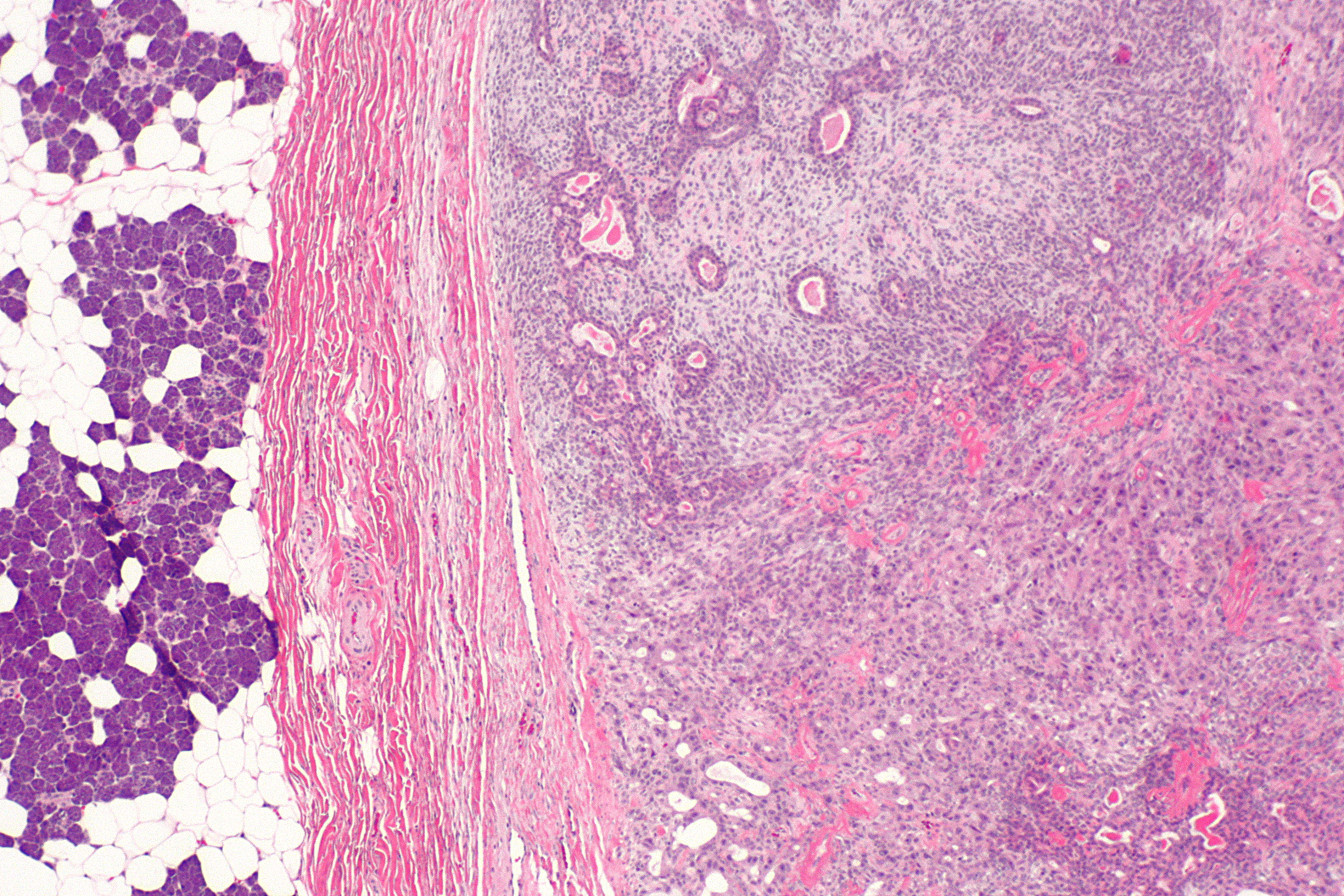 pleomorphic adenoma histology)