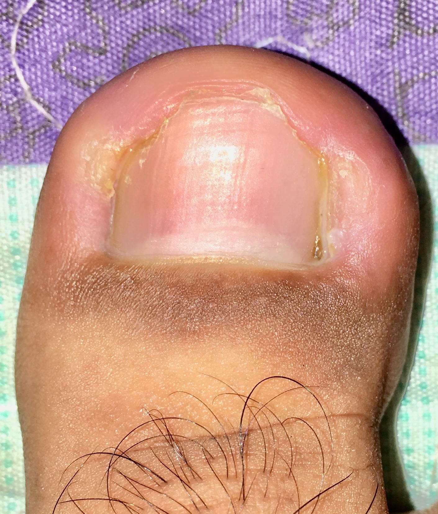 onychomycosis toes icd 10 hogyan lehet diagnosztizálni köröm gomba lábakon