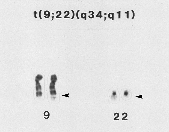 File:Philadelphia chromosome, t(9;22) translocation.jpg