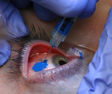 File:Scleral tattooing.jpg