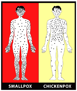 Smallpox_(variola_orthopox_virus_)_Early_Rash_vs_chickenpox.gif