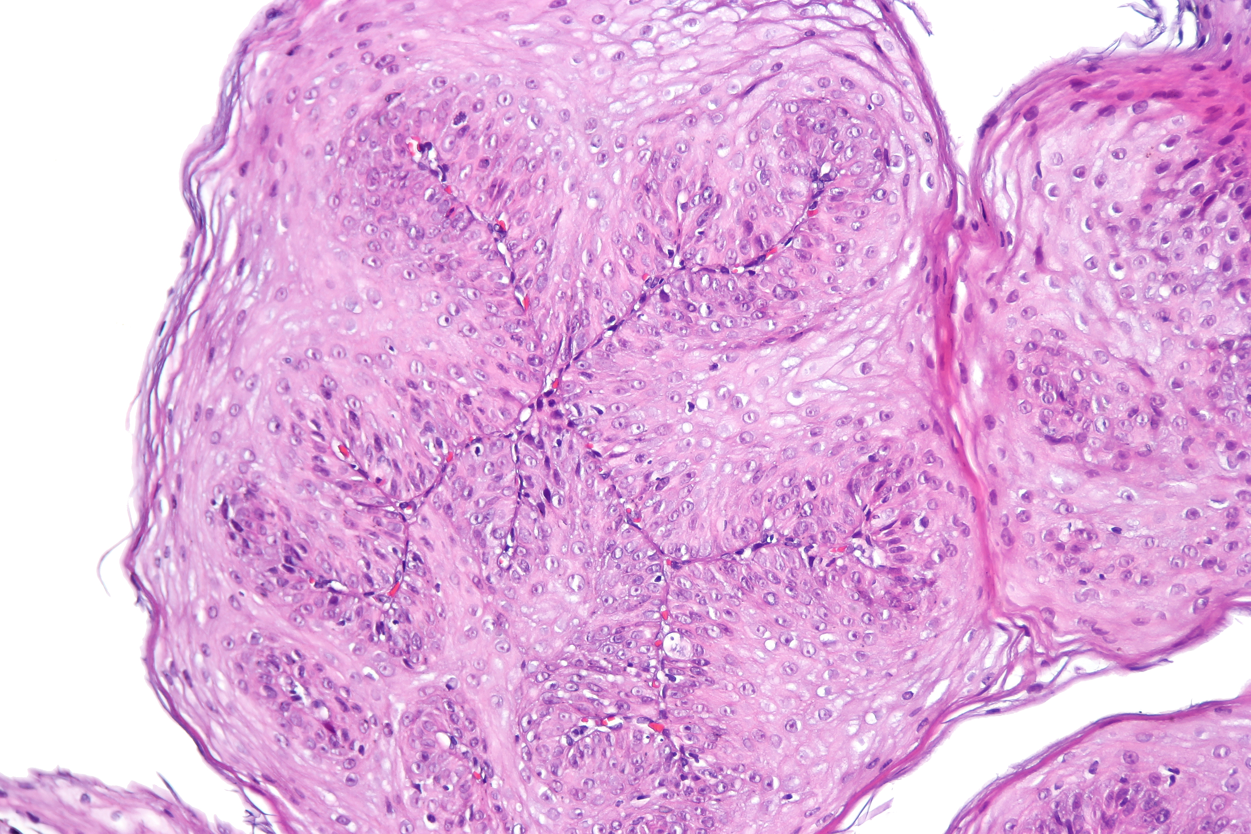 Esophageal squamous papilloma.