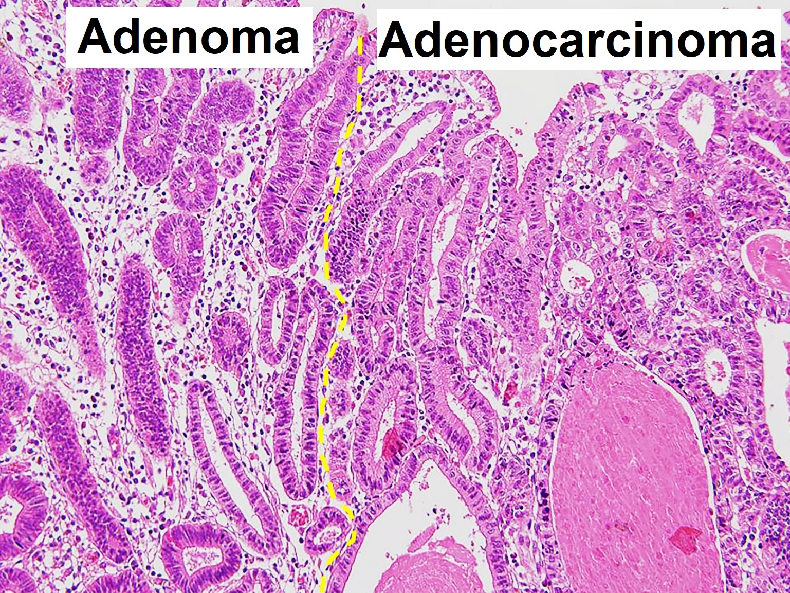 Аденокарцинома желудка гистология. Аденома и аденокарцинома.