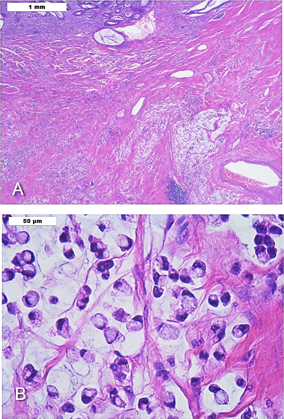 Pathlogos - Not every signet 💍 ring like cell is suggestive of  adenocarcinoma. This here is a macrophage with vaculoation pushing the  nucleus to the periphery seen in pleural fluid. A common