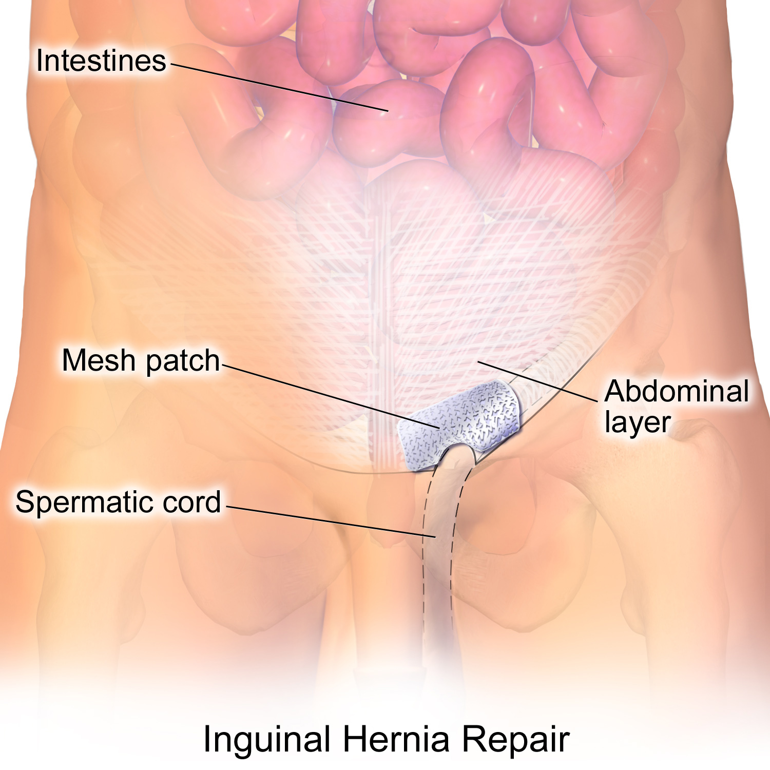 Inguinal hernia - Wikipedia