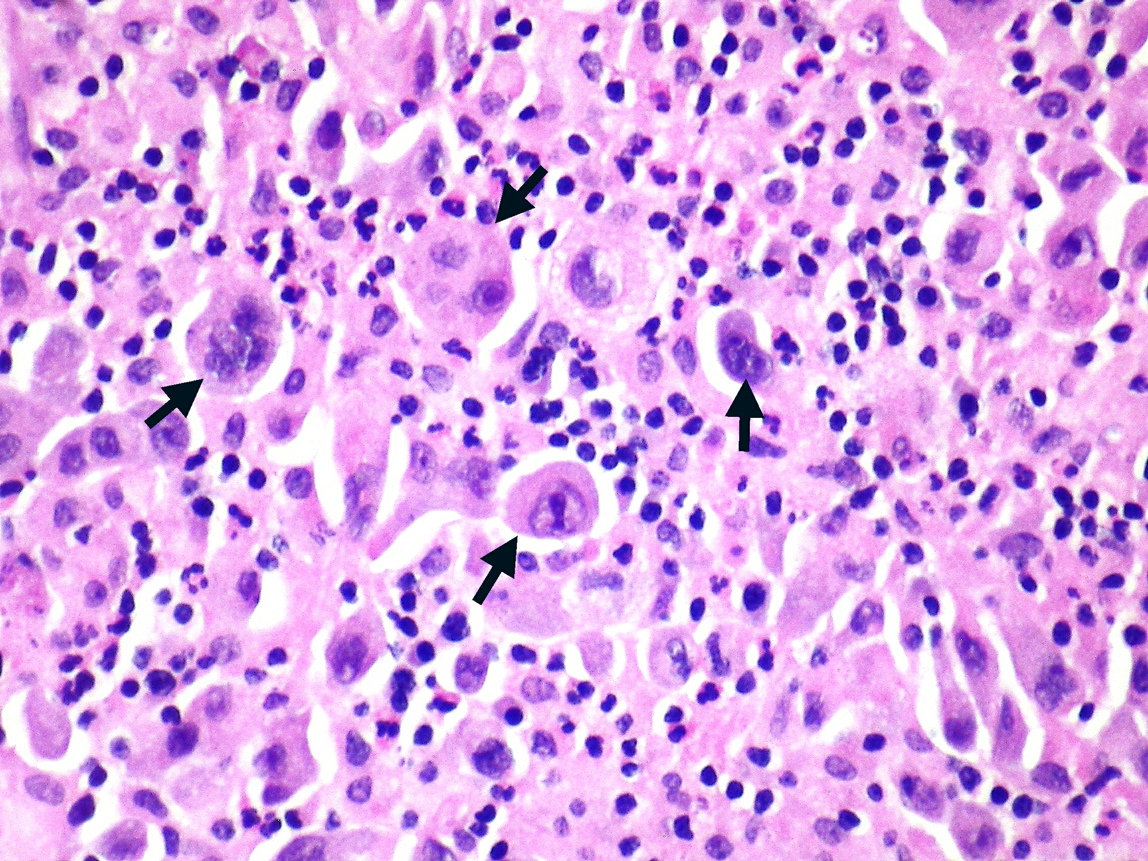 What is non-small cell carcinoma?