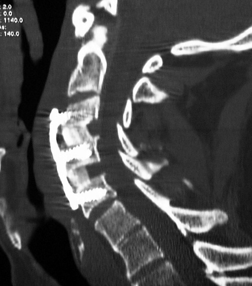 File:Spinal cord compression.jpg