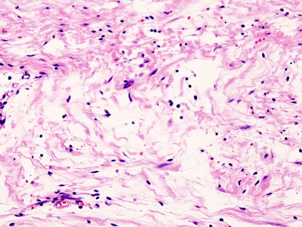 File:Subcutaneous schwannoma (3) Antoni B.jpg