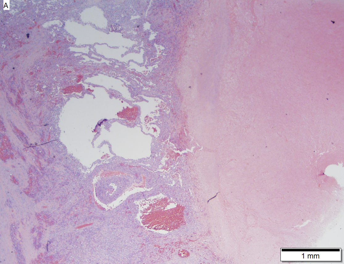 Angiosarcoma of right atrium