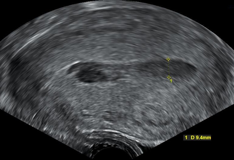 Hematometra - Wikipedia