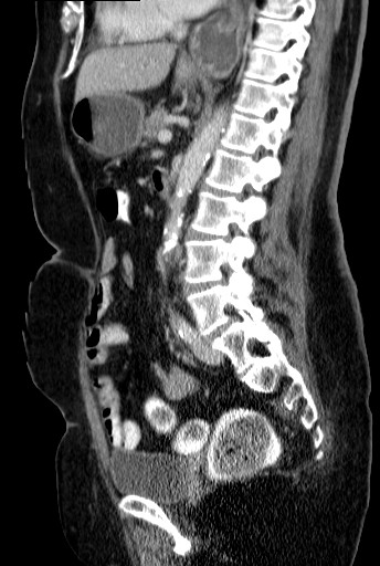 File:Bouveret-Syndrom case 001 - CT - sagittal - 021.jpg