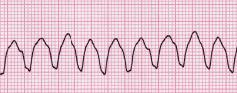 File:Lead II rhythm ventricular tachycardia Vtach VT (cropped).JPG