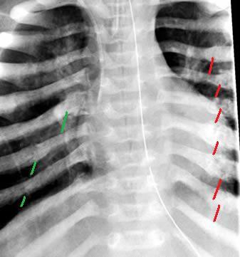 File:Multiple Rib Fractures.jpg