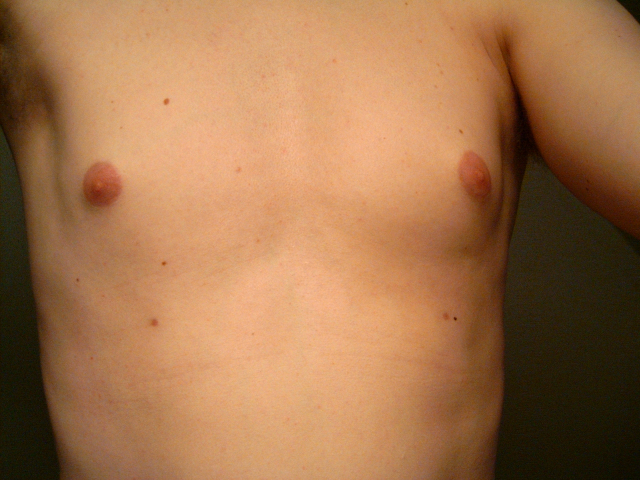 File:20060726 supernumerary nipples.jpg