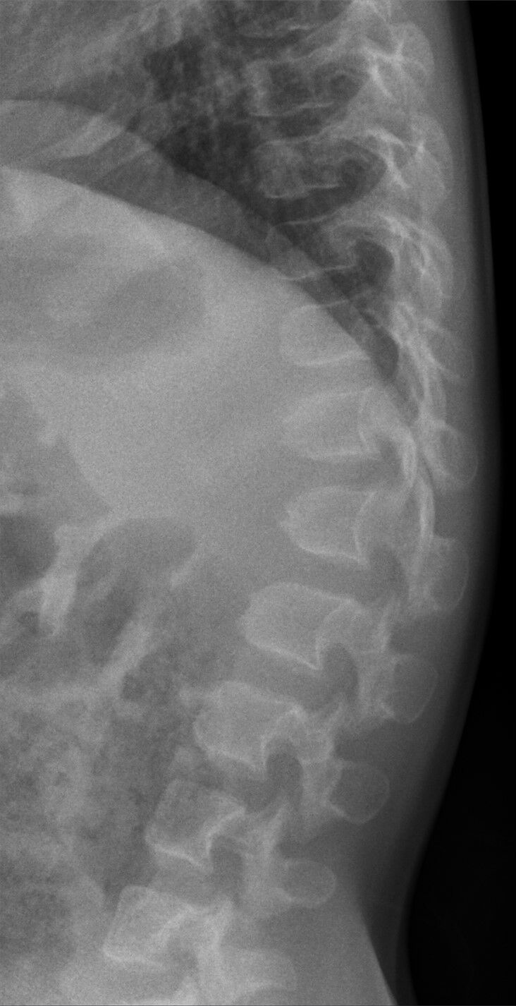 achondroplasia x ray baby