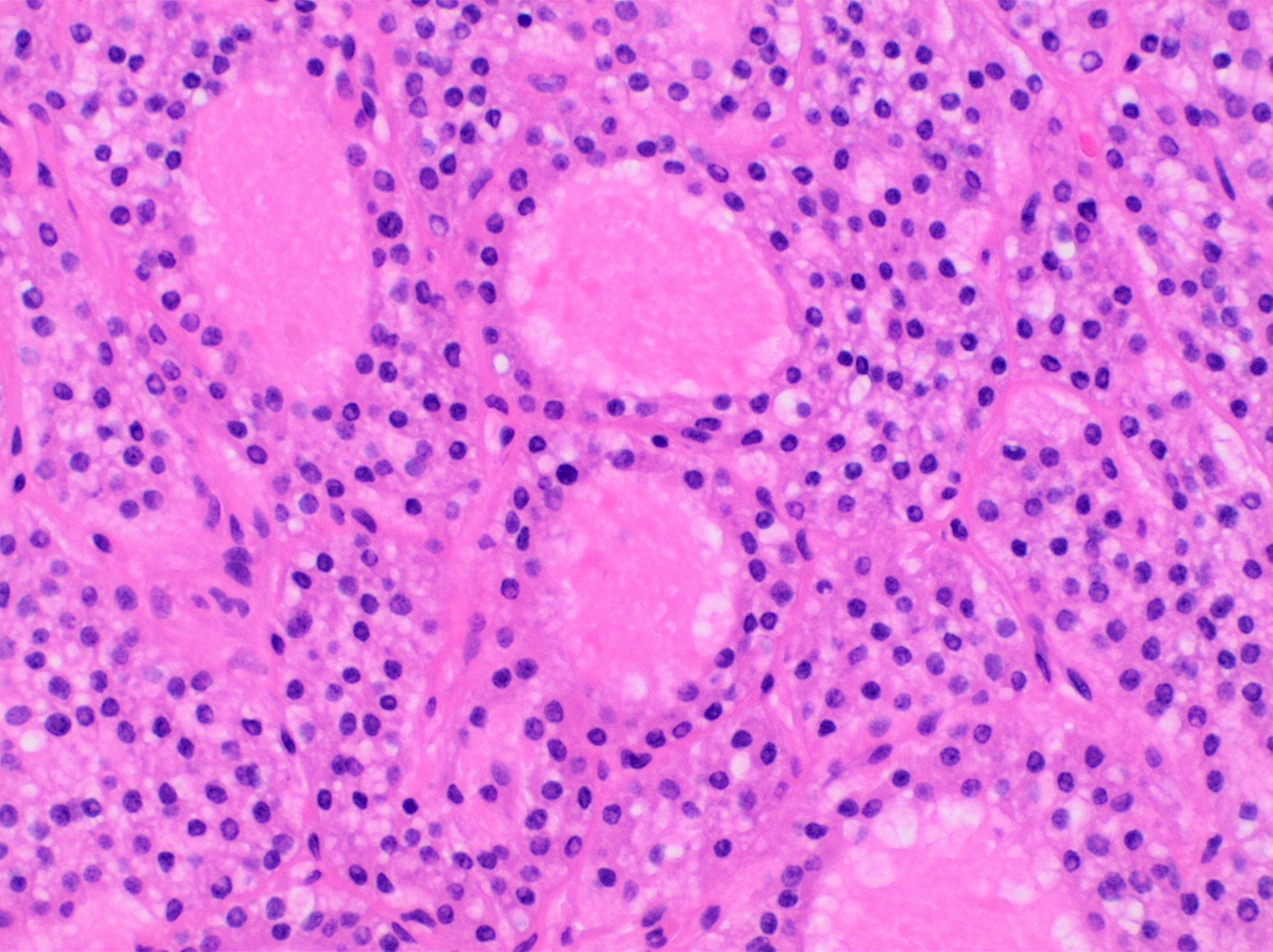 parathyroid adenoma