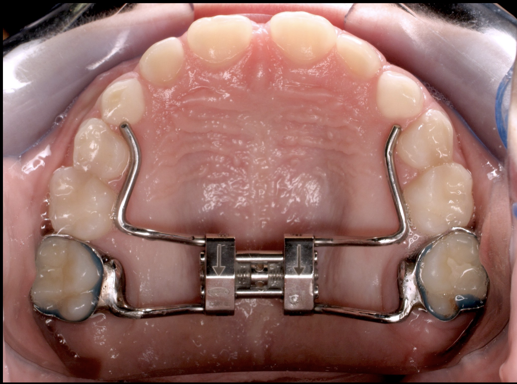 https://upload.wikimedia.org/wikipedia/commons/6/6e/Hyrax_rapid_palatal_expander.png