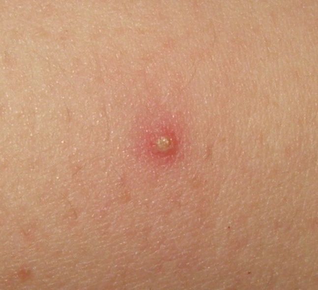 Picture of Folliculitis - WebMD