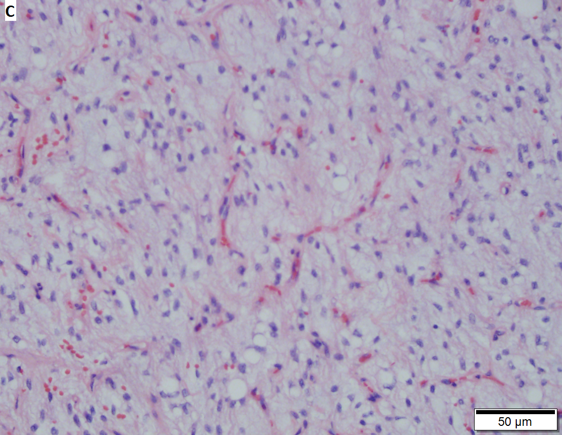 Lipoblastoma like tumor