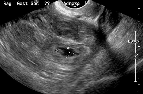 Ultrasound image showing an ectopic pregnancy where a gestational sac and fetus has been formed.