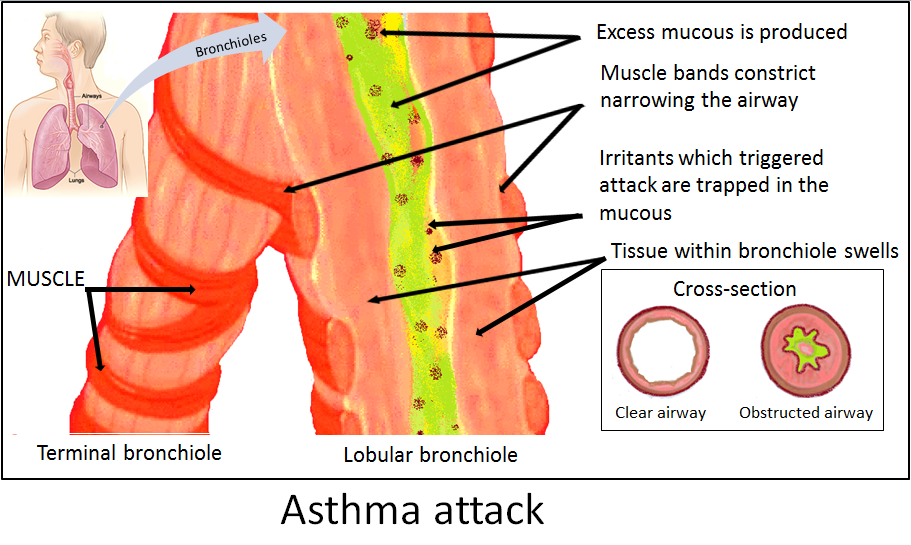 Asthma_attack