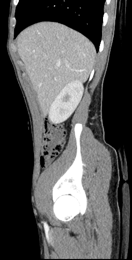 CT of a normal abdomen and pelvis, sagittal plane 47.png