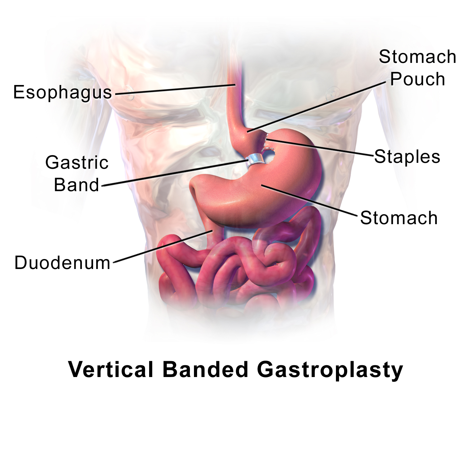 Bariatric Surgeries - Estetikworld