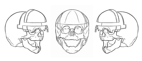 Fig. 4 Bone segments that are removed in fronto-supraorbital advancement Bone segments removed in fronto-supraorbital advancement.png