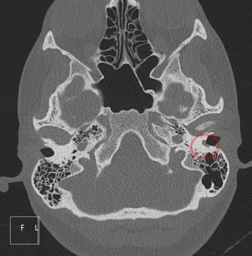 Cholesteatom CT Axial KF.jpg