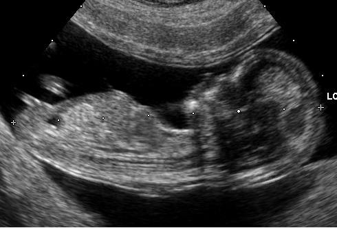 File:Embryo at 12 weeks.JPG