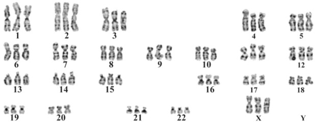 File:Human triploid karyotype.jpg