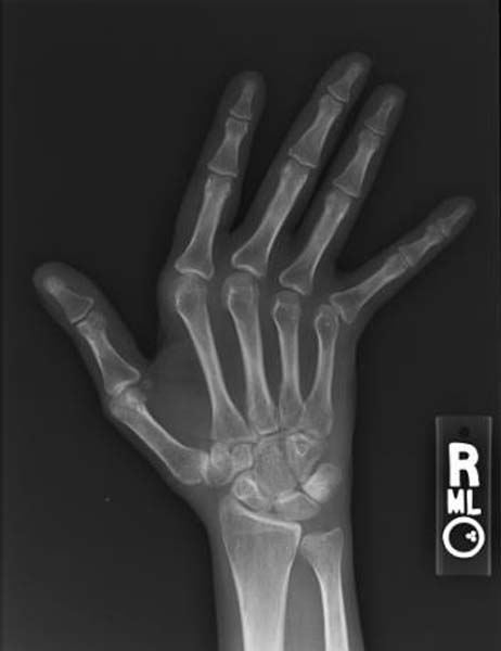 Arthritis - Wikipedia