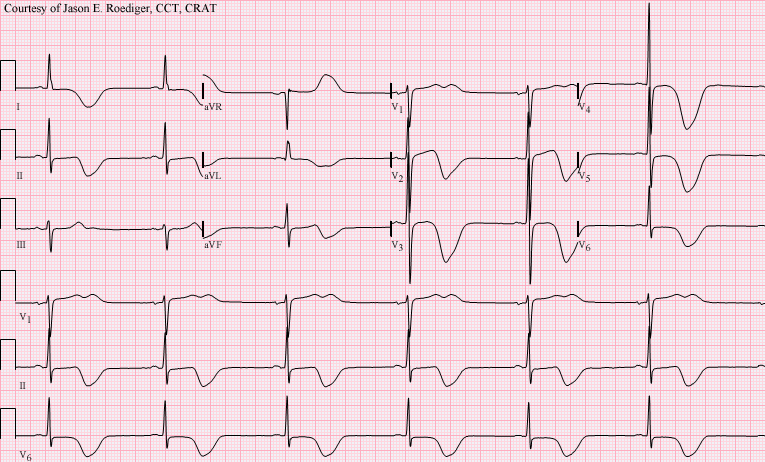 File:Left MCA Stroke.png